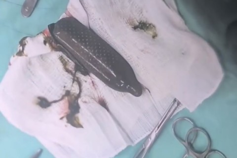 homem passa por cirurgia no Hospital do Paranoá após engolir pacote de droga